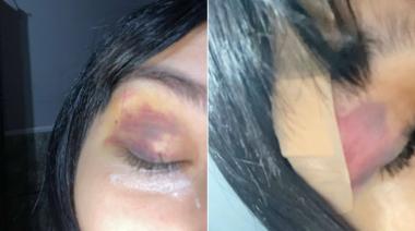 Brutal ataque en patota a una adolescente de 14 años a la que desfiguraron a golpes y le robaron el celular