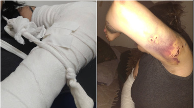 Casí la devoró un pitbull, y ahora no puede trabajar ni mantener a sus hijos