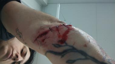 Sobrevivió al ataque de un pitbull, casi pierde el brazo y no puede trabajar: "No se hacen cargo"