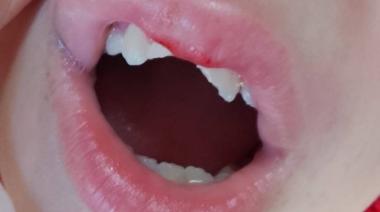Aseguran que le rompieron dos dientes a un nene víctima de bullying