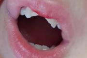 Aseguran que le rompieron dos dientes a un nene víctima de bullying